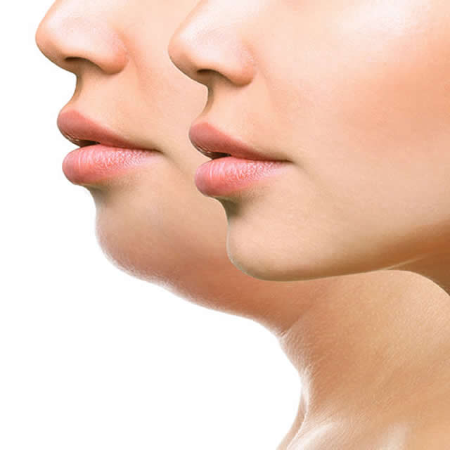 RINOPLASTIA-ULTRASONICA-GUAYAQUIL